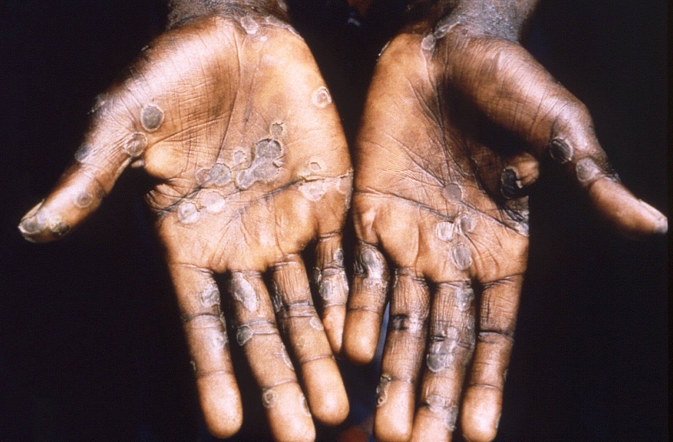 Active monkeypox virus cases continue to drop in Malaga province