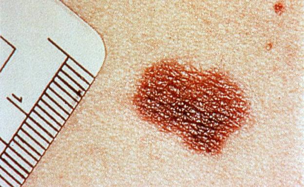 Melanoma, tumor cutáneo asociado a la exposición al sol. 