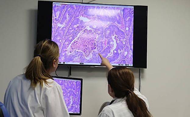 Cáncer de ovario: 10 nuevos casos al día de un tumor difícil de diagnosticar