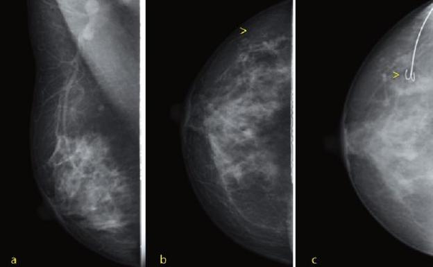 Aumentan los casos de cáncer de mama pero también el índice de curación