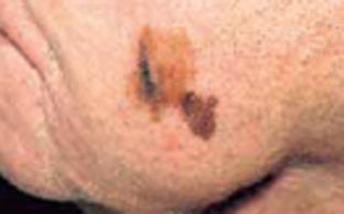 Melanoma