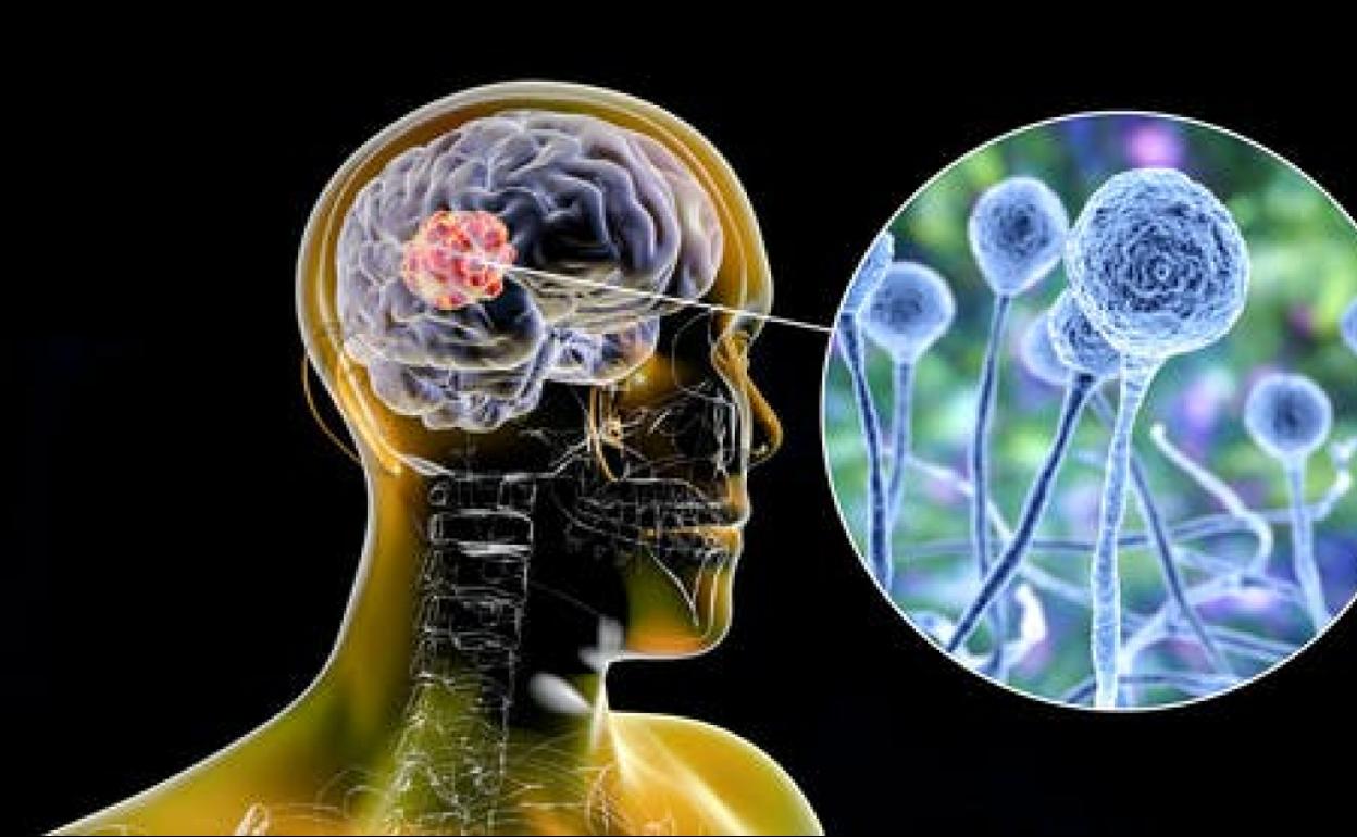 Mucormicosis: ¿por qué afecta a los pacientes de coronavirus?
