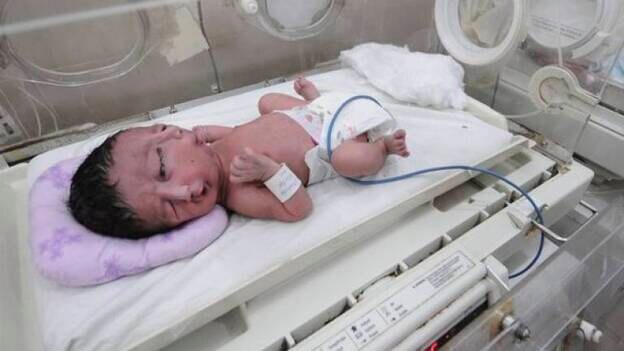 Nace un niño con dos caras en una cabeza en Pakistán
