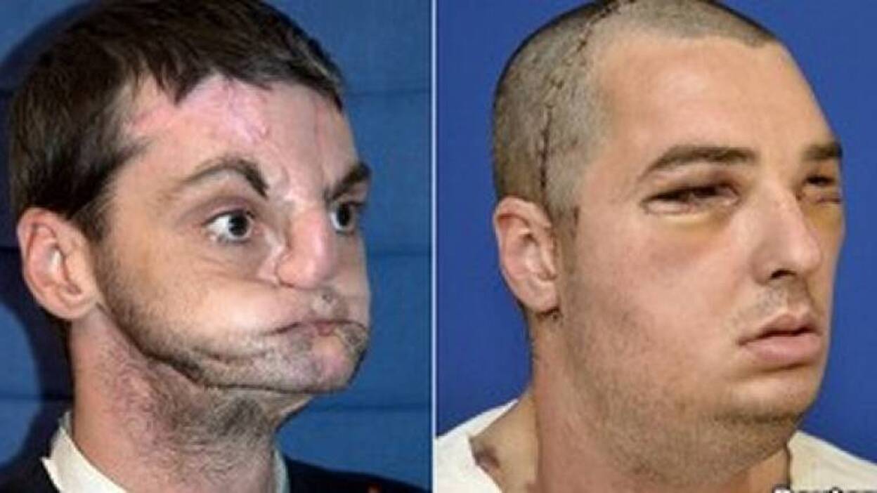 Cirujanos de EEUU realizan el trasplante de cara "más completo"