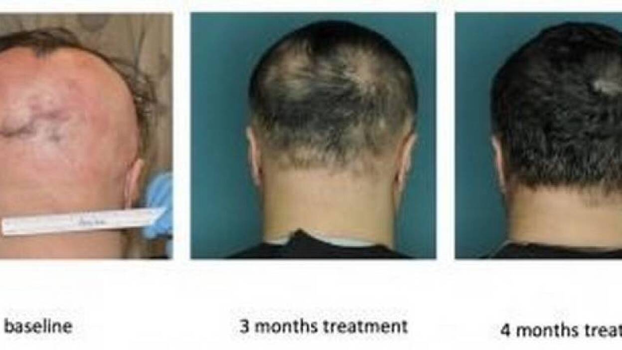 Un nuevo crecepelo revierte un tipo de alopecia en apenas cinco meses