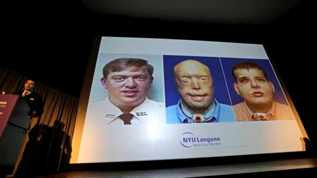 El trasplante de cara más complejo hasta la fecha