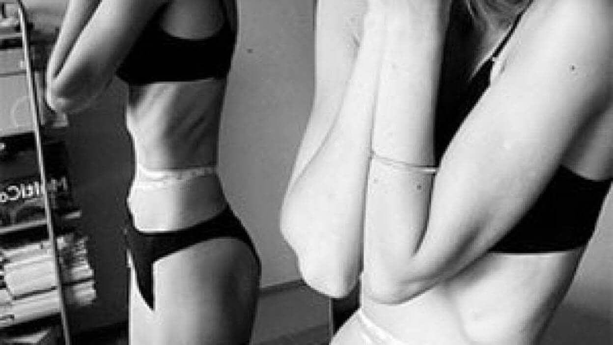 Las nuevas caras de la anorexia: chicas más jóvenes y chicos más visibles