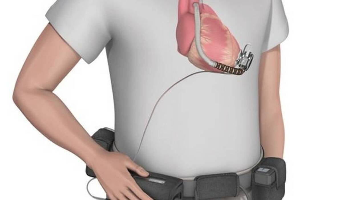 Corazones artificiales duraderos se afianzan como alternativa al trasplante