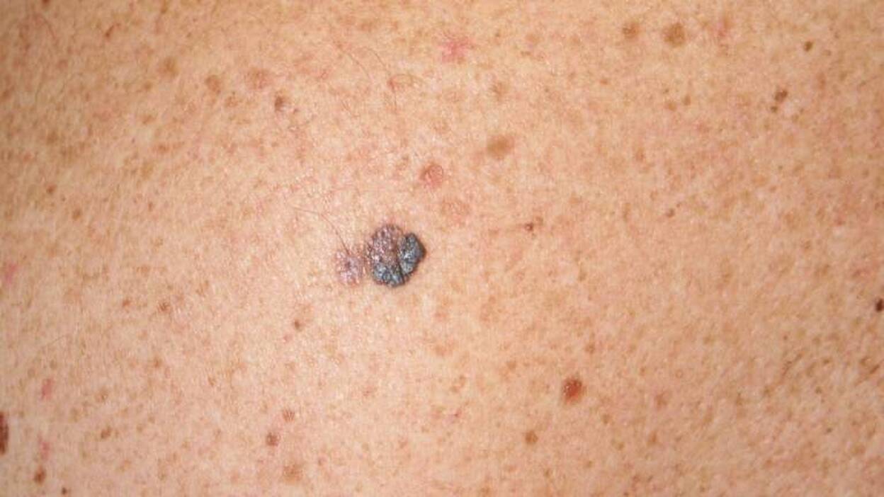 Quemaduras solares multiplican por dos la posibilidad de sufrir un melanoma