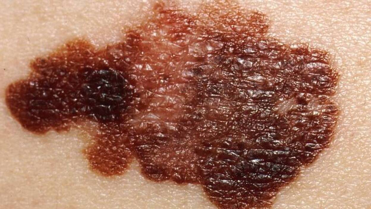 Desarrollan un sistema para clasificar melanomas a partir de imágenes dermatoscópicas