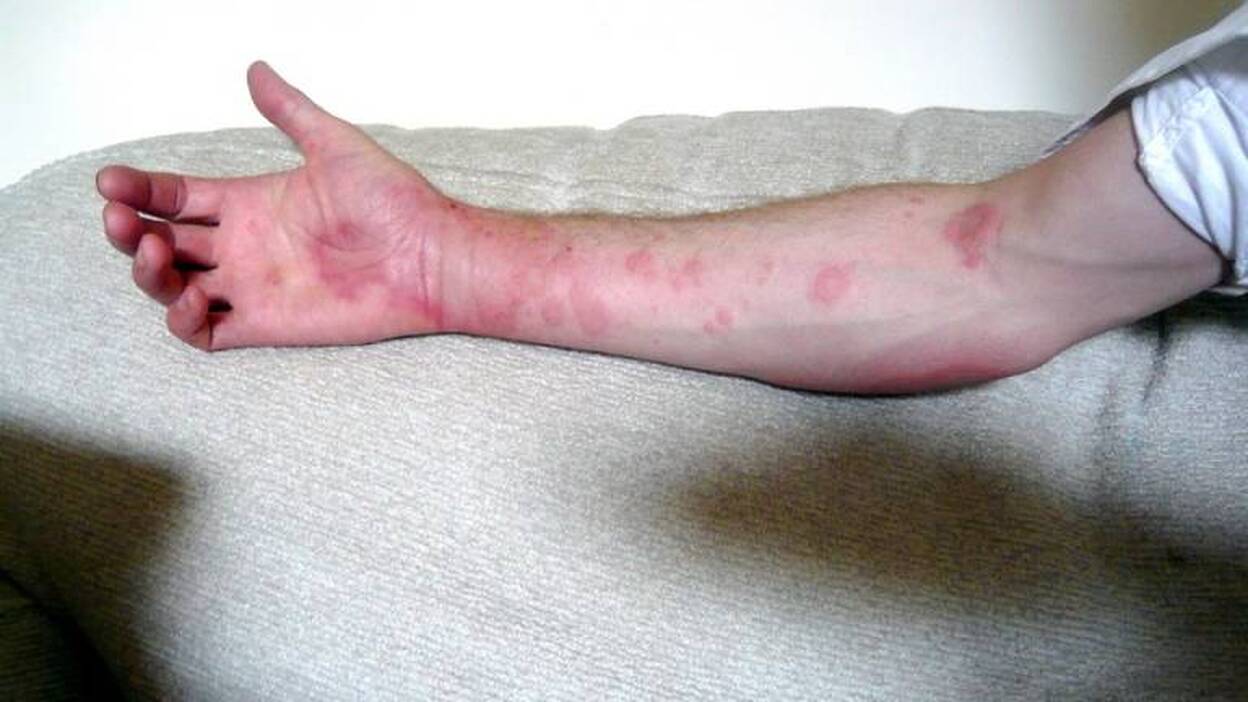 Recomiendan extremar las precauciones en verano ante el aumento de urticarias en niños