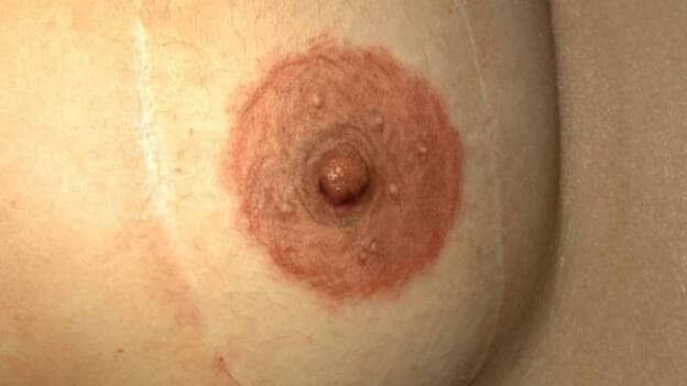 Ya es posible &#039;recuperar&#039; la areola de la mama tras una mastectomía gracias a la técnica de micropigmentación