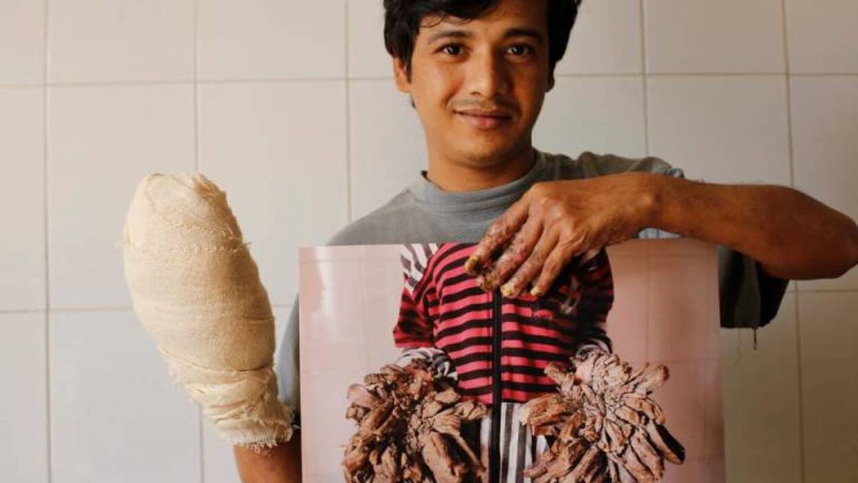 El 'hombre árbol' recupera sus manos