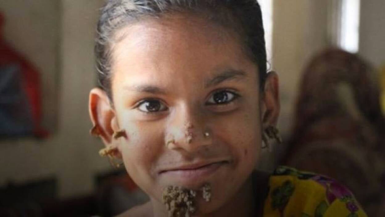 Diagnostican a una niña en Bangladesh la enfermedad del "hombre árbol"