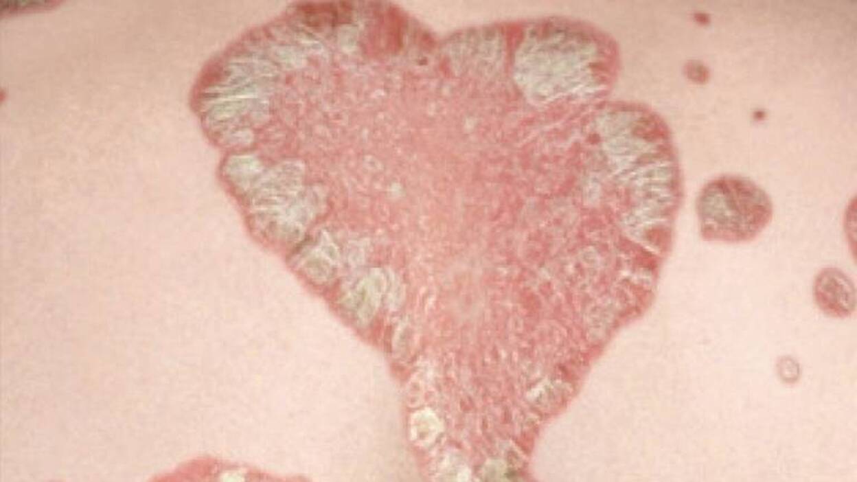 Un nuevo medicamento biológico aclara casi totalmente las placas de psoriasis