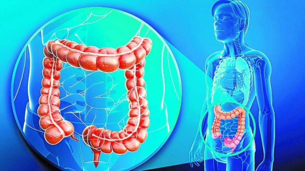 Avances ante el cáncer colorrectal