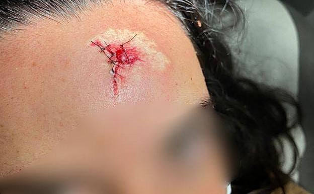 Un detalle del daño que le produjo en la frente el impacto de la piedra. 