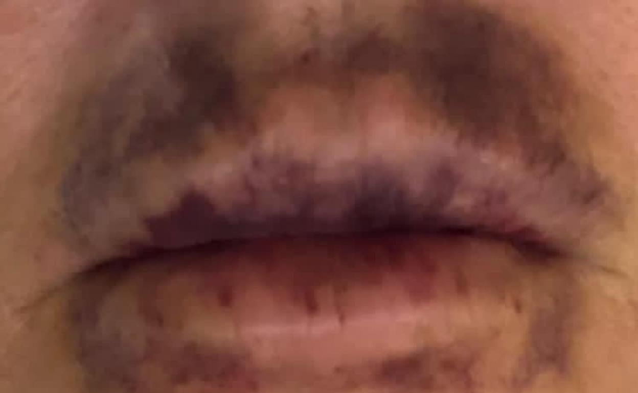 Lesiones en la zona labial de una de las personas que probó el producto. 