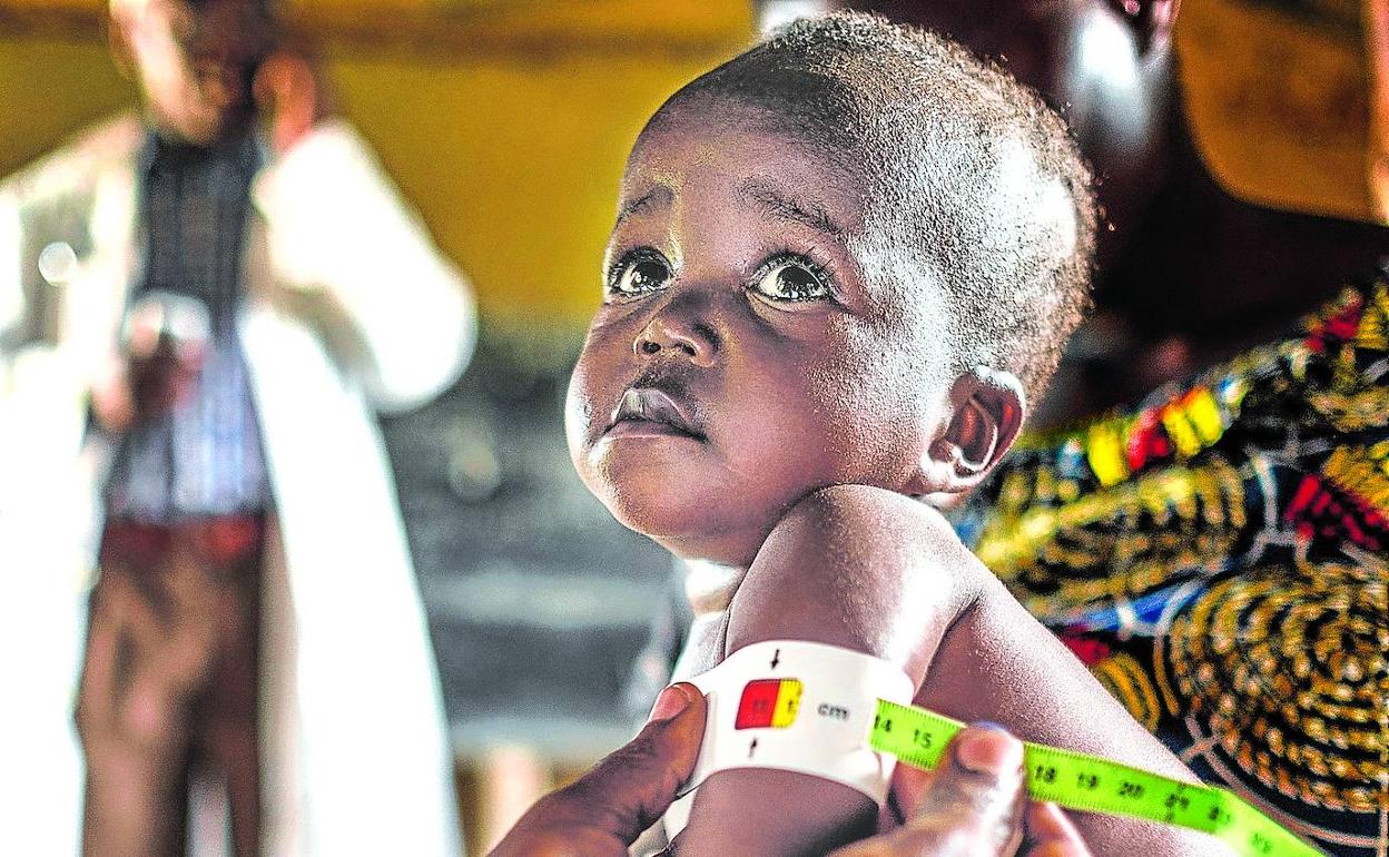 Niño desnutrido atendido en un centro de atención y salud en el Congo.