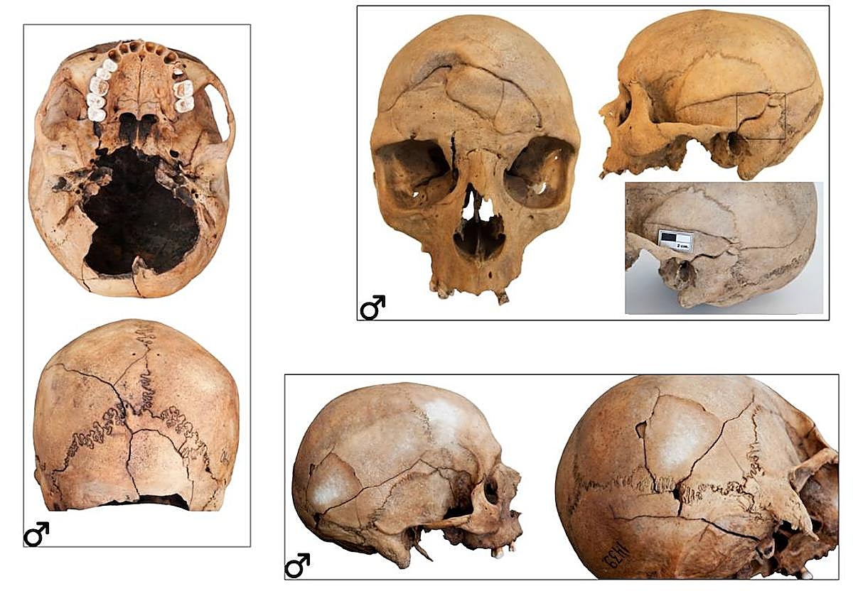Esta es una de las imágenes mostradas en la charla. Recoge lesiones diversas en varios cráneos de individuos de antiguos canarios.