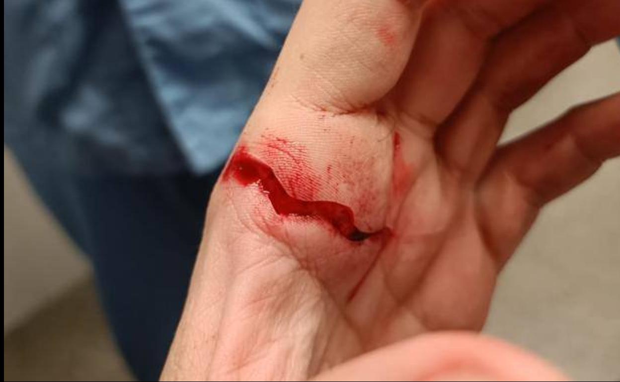 El entrenador del Firgas, Daniel José Travieso, sufrió una puñalada en la mano izquierda el pasado sábado, tras disputar un partido contra el Unión Pedro Hidalgo B. 