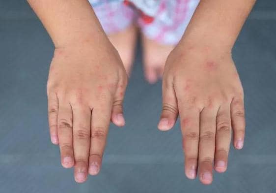 Imagen de las manos de una niña afectada por escabiosis.