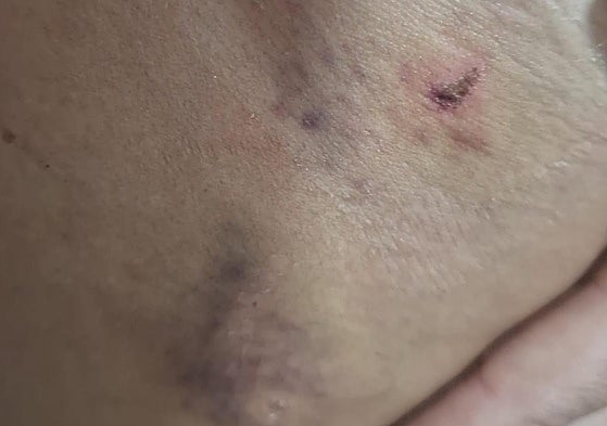 Heridas de la afectada.