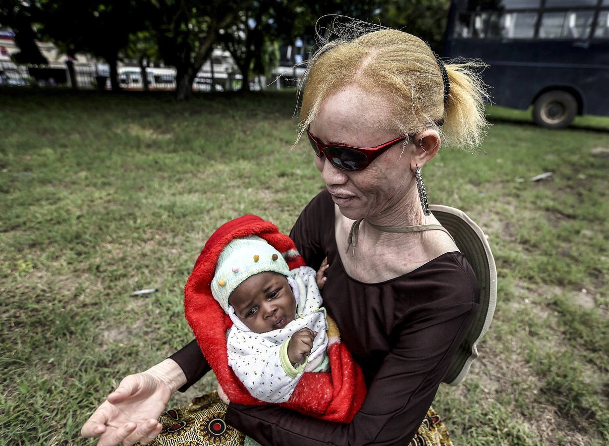 El drama de los albinos de Tanzania