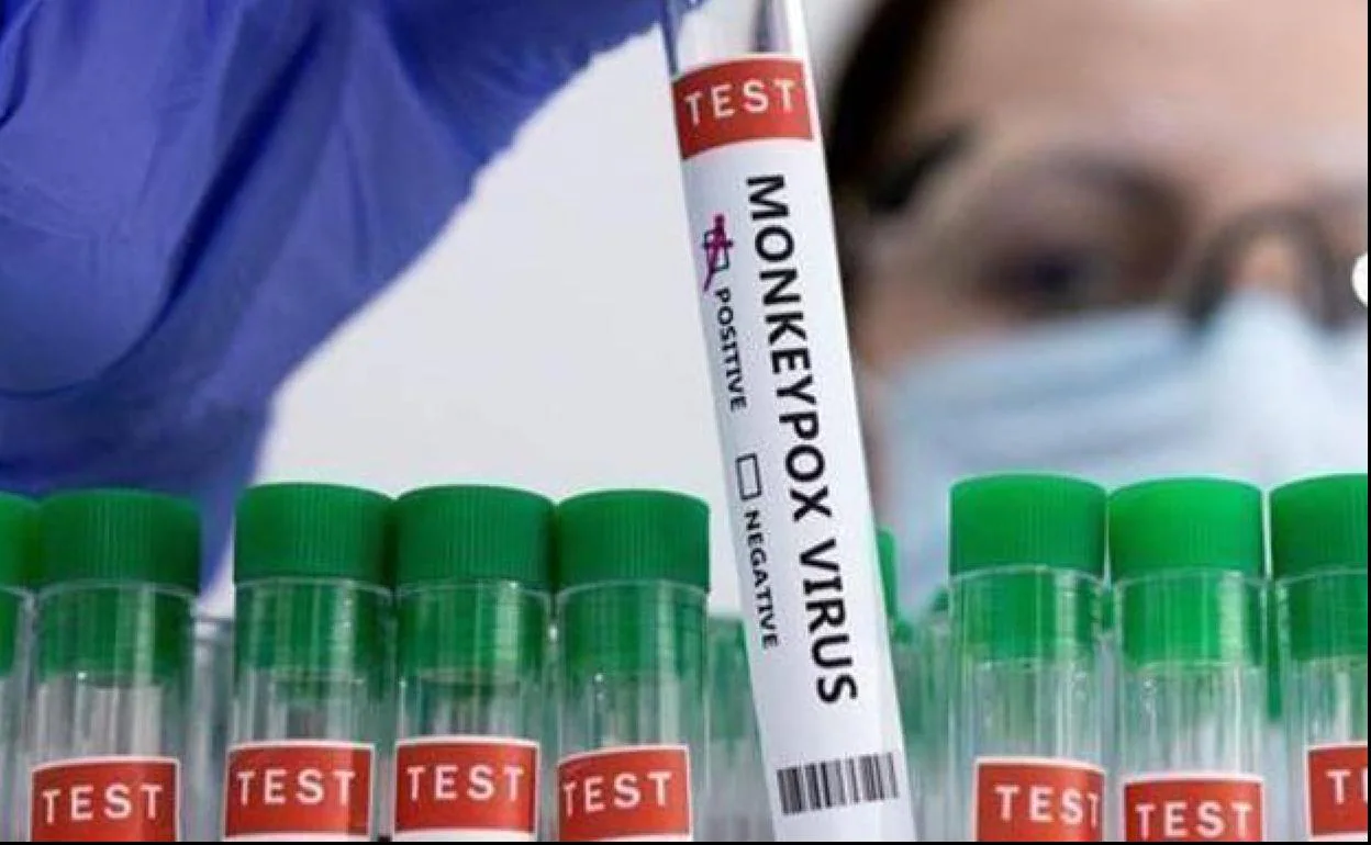 Andalucía registra 27 casos activos de viruela del mono, con 54 más en investigación