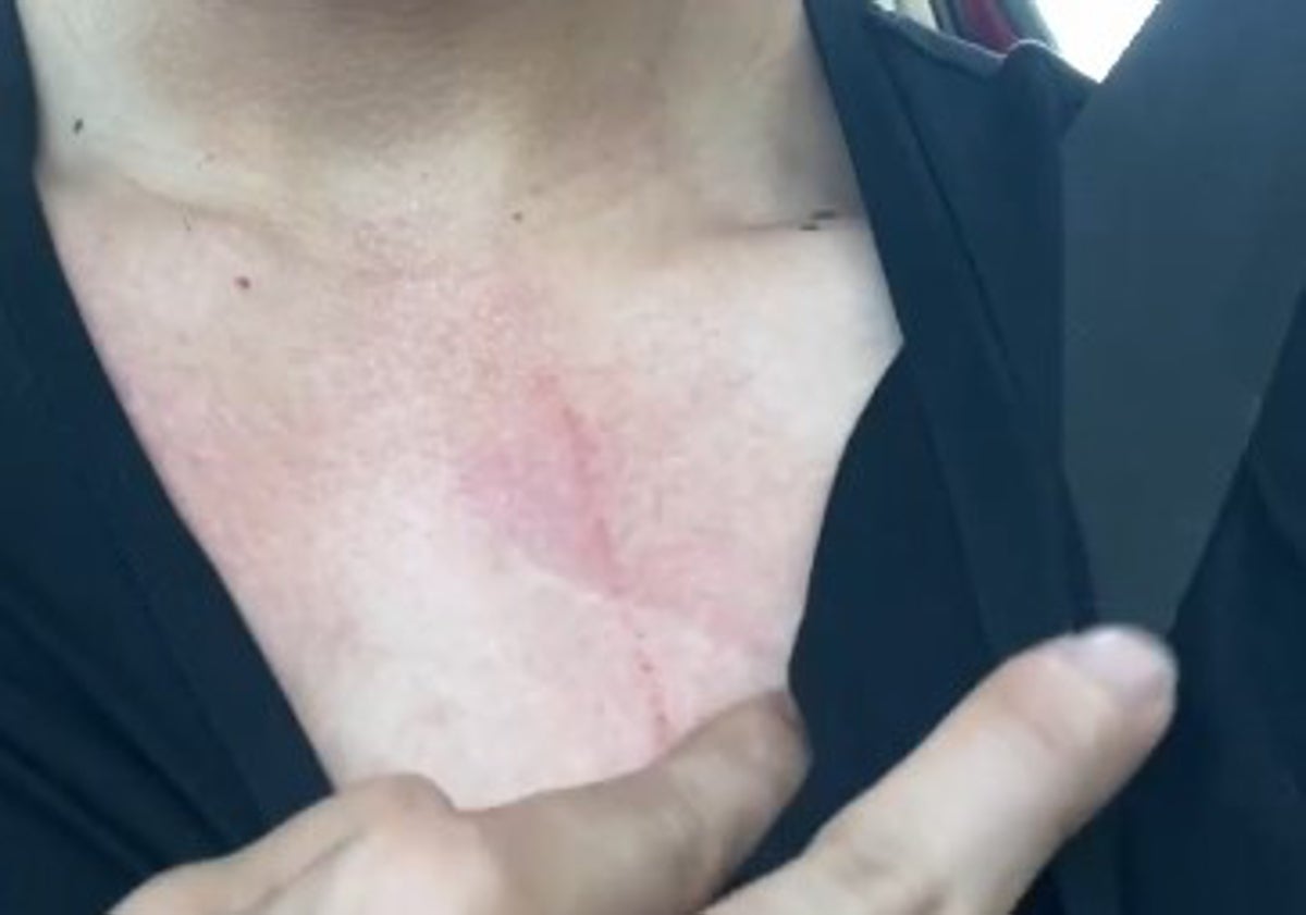 Imagen principal - En las imágenes, los rasguños que sufrió el joven en el pecho, el cuello y la cabeza al tratar de retener a uno de los ladrones.