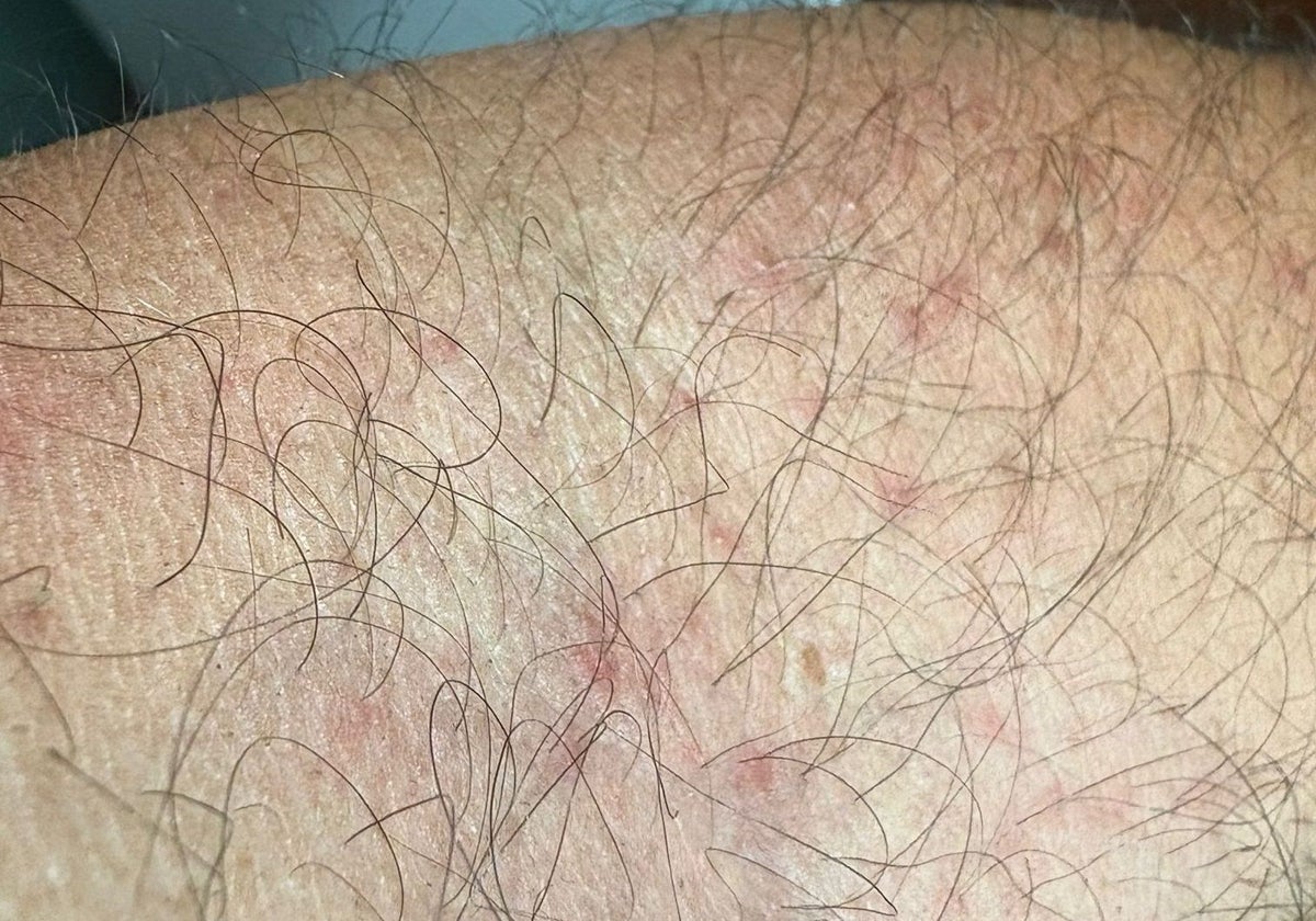 Trabajadores denuncian que hay chinches en el aeropuerto de Málaga