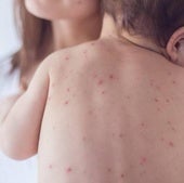 Andalucía mantiene aún activos seis brotes de sarampión