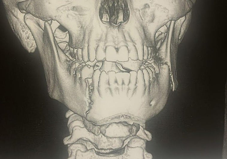 Un menor de 14 años, hospitalizado tras una grave agresión en un instituto de Fuengirola