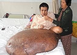 Operan a un vietnamita con un tumor de 90 kilos en la pierna