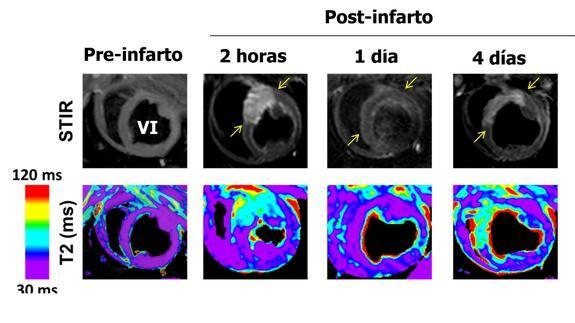 Imágenes de resonancia magnética del mismo sujeto en diferentes momentos de la primera semana post-infarto.