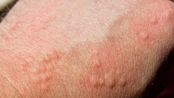 Los pacientes denuncian el mal uso del término “urticaria”