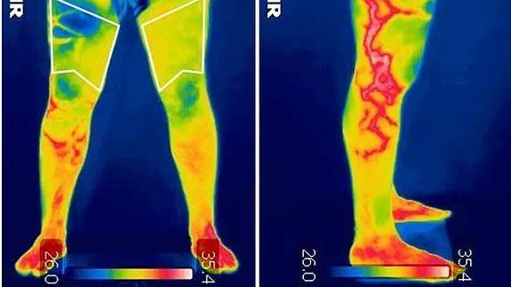 A la izquierda, toma de datos de las regiones de interés lesionadas y no lesionadas (cuádriceps derecho con rotura muscular moderada). Derecha: toma lateral del mismo sujeto en el que se aprecia un posible problema vascular que supone una información adicional para el traumatólogo y que es imposible percibir a simple vista. / Grupo de Investigación TermoINEF.