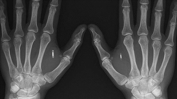 Radiografía de las manos de Aaron Graafstra con el chip implantado.