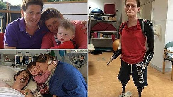 Alex Lewis, con su familia, en el hospital y con sus prótesis. 