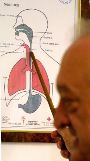 El Clínico implanta una prótesis para que personas sin laringe hablen