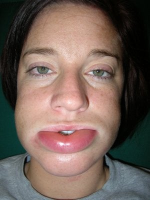 Una paciente, antes y después de sufrir un ataque súbito de angioedema hereditario. ::
SUR