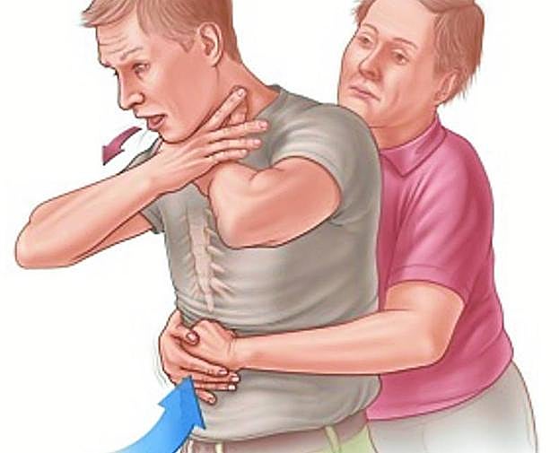 Maniobra de Heimlich. 