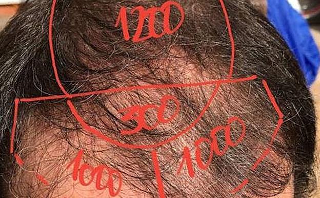 Cálculo de las unidades foliculares a injertar en las diferentes partes de la cabeza. 