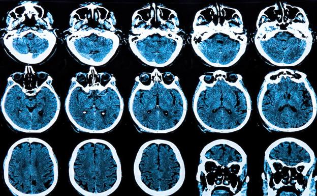 Escaner cerebral de un paciente.