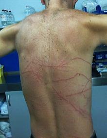 Imagen secundaria 2 - Arriba, recogida de ejemplares. Abajo izquierda, una carabela flotando en la bahía. A la derecha un bañista muestra las marcas que le dejó la picadura de una carabela. 