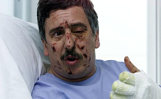 Landaburu, en la cama del hospital Donostia, con las heridas del rostro visibles y las manos vendadas, en una fotografía tomada tres días después del atentado. 