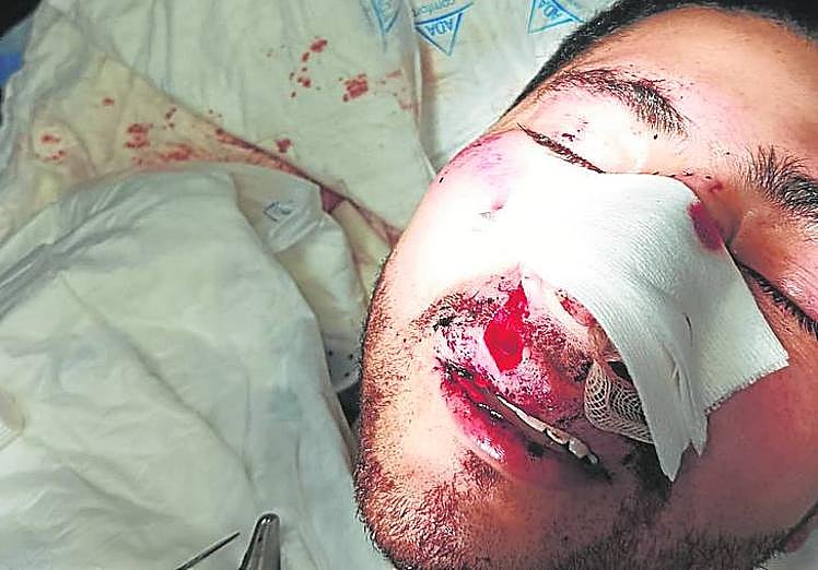 Imagen principal - Moratones y una nariz, una cara y una muñeca rotas . El puñetazo que recibió Carla le ha dejado como marca un moratón en el ojo. También presenta hematomas y cortes Yeisson. Peor parado salió Brayan, con la nariz, la cara y una muñeca rota. 