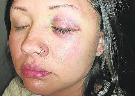 Imagen secundaria 1 - Moratones y una nariz, una cara y una muñeca rotas . El puñetazo que recibió Carla le ha dejado como marca un moratón en el ojo. También presenta hematomas y cortes Yeisson. Peor parado salió Brayan, con la nariz, la cara y una muñeca rota. 