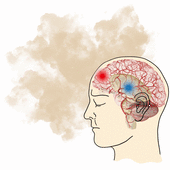 ¿Qué es el ictus? ¿Qué lo provoca?