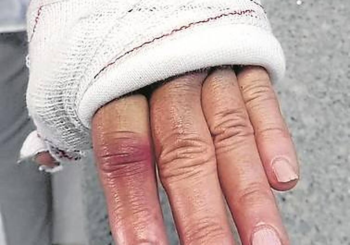 La mano lastimada por una piedra.